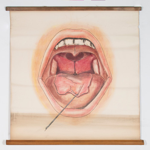 Prikaz usta i ždrijela za vrijeme operacije atrezije nosnoga ždrijela