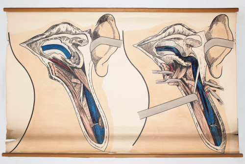 Operacijsko otvaranje sinusa mastoideusa desnoga uha