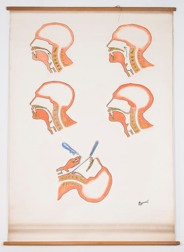 Operacije pri nazalnom govoru (Schönborn – Šercer)