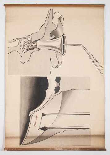 Shematski prikaz paracenteze (zasijecanja bubnjića)