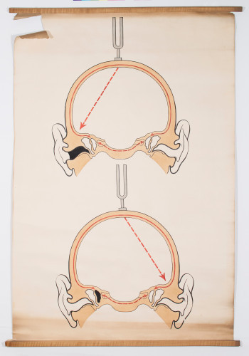 Ispitivanje sluha glazbenim viljuškama: Weberov pokus