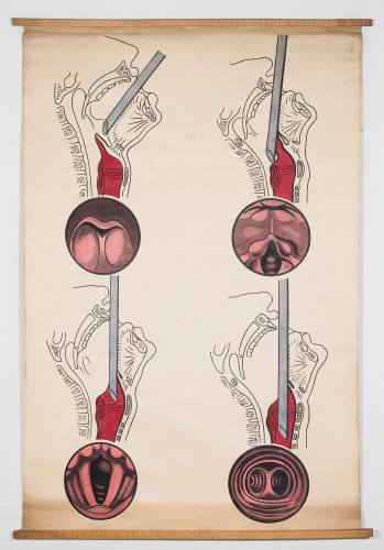 Grafički prikaz bronhoskopije