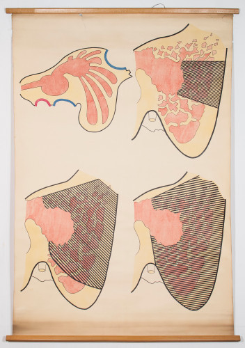 Razvoj mastoidnog nastavka temporalne kosti i opsezi raznih operacija na njemu (mastoidektomija)