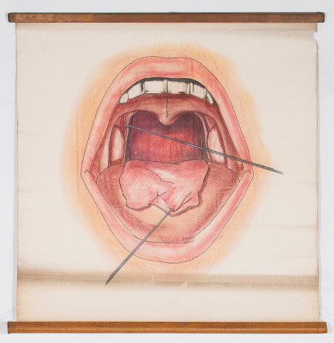 Dio kirurškog tretmana (otvaranja) retrotonzilarna apscesa desno