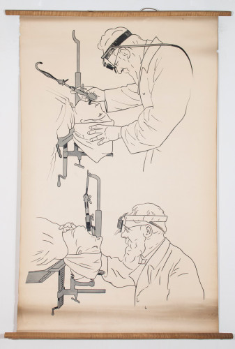 Prikaz direktoskopskog pregleda grkljana