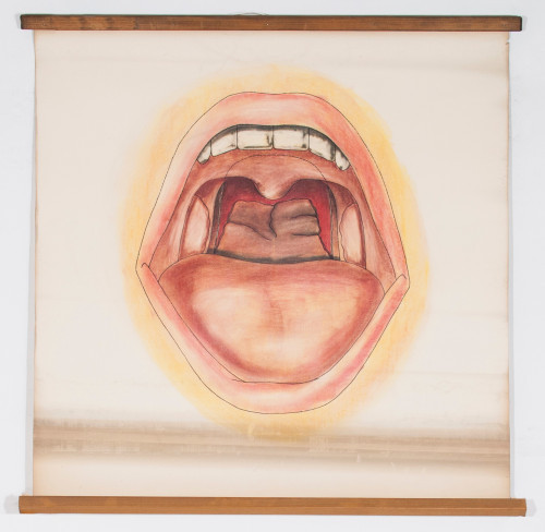 Prikaz usta i ždrijela prije operacije atrezije nosnoga ždrijela