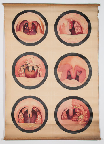 Kliničke slike ždrijela i nepčanih tonzila pri raznim vrstama upala