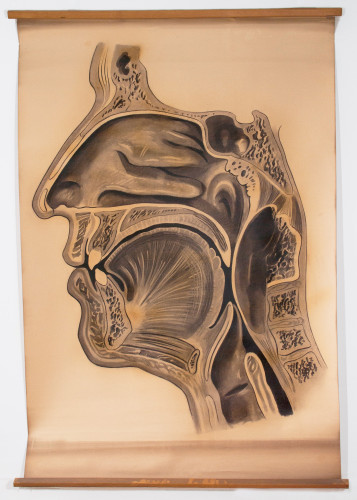 Faringealno suženje zbog tumefakta u području klivusa i atlasa