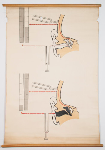 Shematski prikaz akumetrijskog ispitivanja koštane i zračne provodljivosti zvuka 
(ispitivanje sluha zvučnom viljuškom, odnosno Rinneov, Weberov i Schwabachov test)