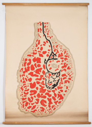 Crtež histološkog nalaza tkiva uzetog pri bronhoskopiji