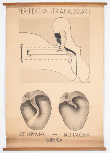 Izgled strije malearis u slučajevima normalnog i uvučenog bubnjića
