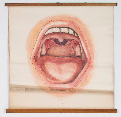 Prikaz usta i ždrijela na kraju operacije atrezije nosnoga ždrijela