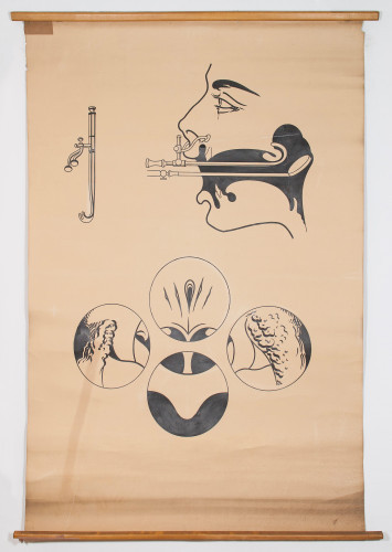 Shematski prikaz izvođenja i uobičajenih nalaza stražnje rinoskopije