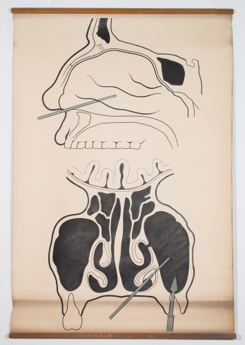 Shematski prikaz punkcije lijevog čeljusnog sinusa