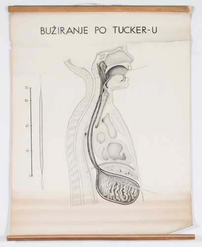 Bužiranje jednjaka po Tuckeru