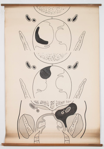 Shematski prikazi vodoravnih presjeka ždrijela (gore i u sredini) i jednog vertikalnog (dolje) u slučaju tumefakta u retro-tonzilarnoj regiji