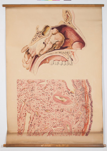 Rinološka slika (gornji crtež) i histološka slika juvenilnog angiofibroma