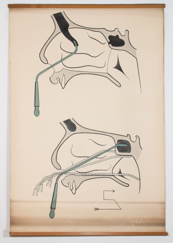 Presjek nosne šupljine s (teorijskim) mogućnostima uvođenja rinoloških instrumenata u čeoni i sfenoidalni sinus